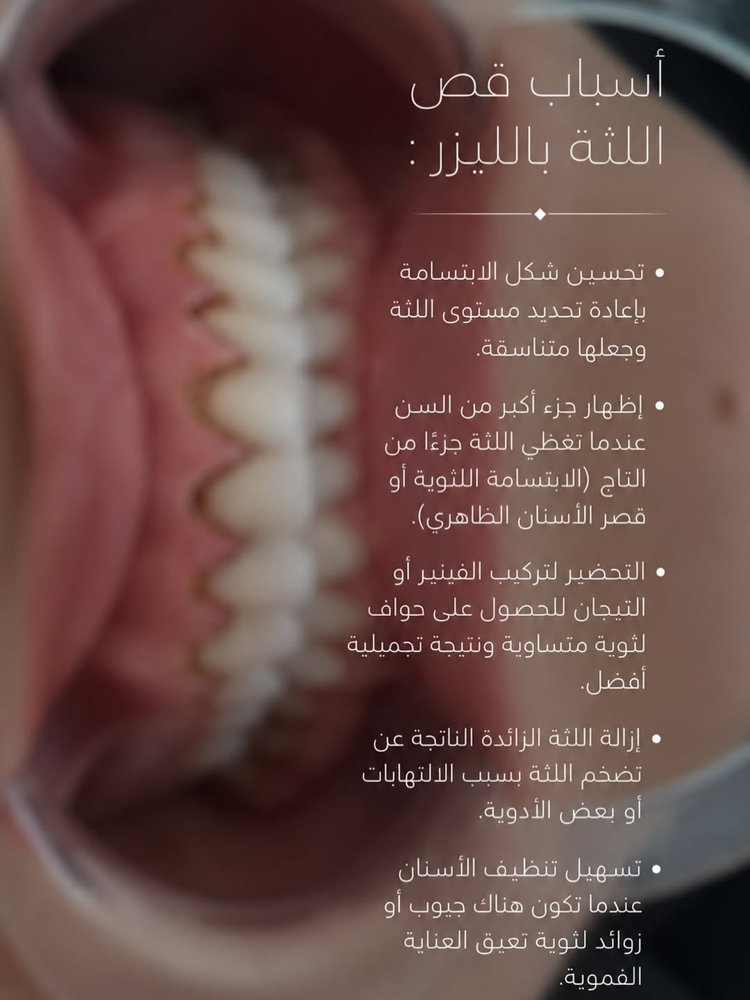 تحديد اللثة بالليزر