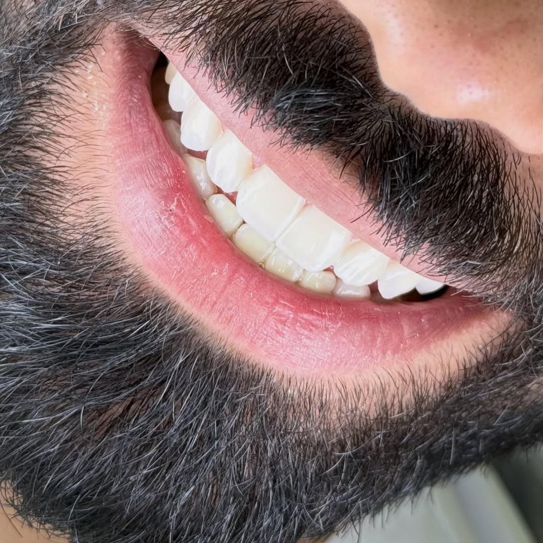 ابتسامة طبيعية بعد عناية أسنان في بيلا دنت